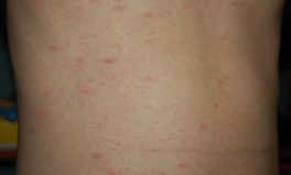 疥瘡私密,私密部位困擾的根源與防治策略